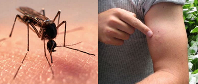 аллергия на комариные укусы