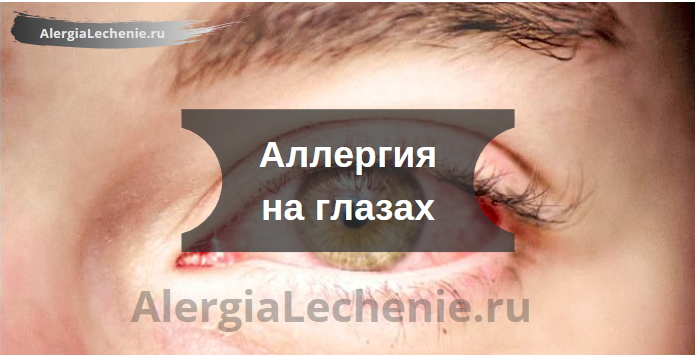 Аллергия на глазах: диагностика, симптомы и лечение